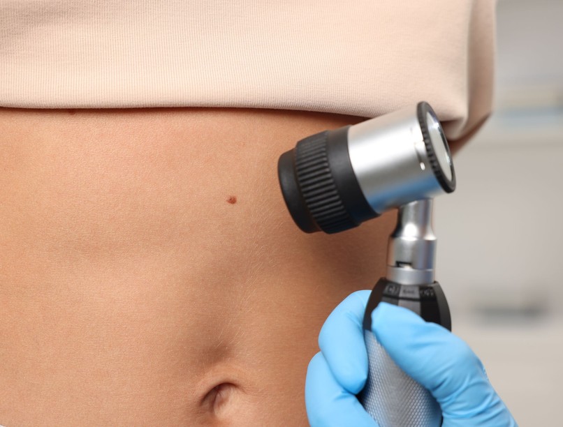 anyajegyszűrés vérző anyajegy változás