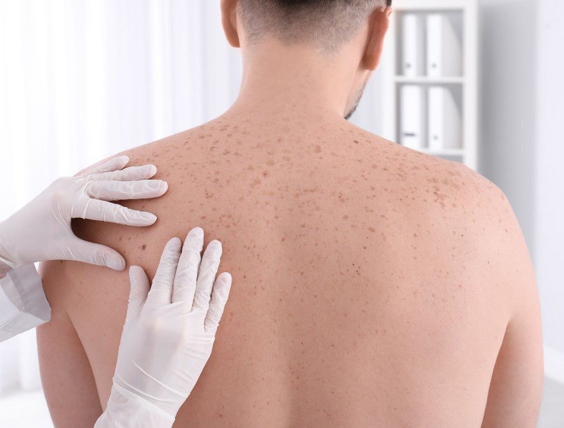 anyajegyszűrés, dermatológus, anyajegy, bőrrák, melanoma