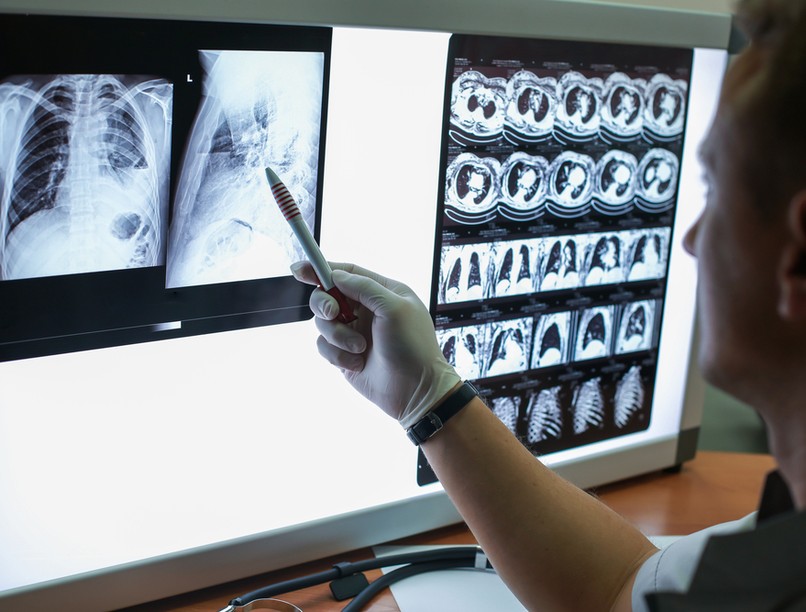 CT, tüdőrák, szűrés