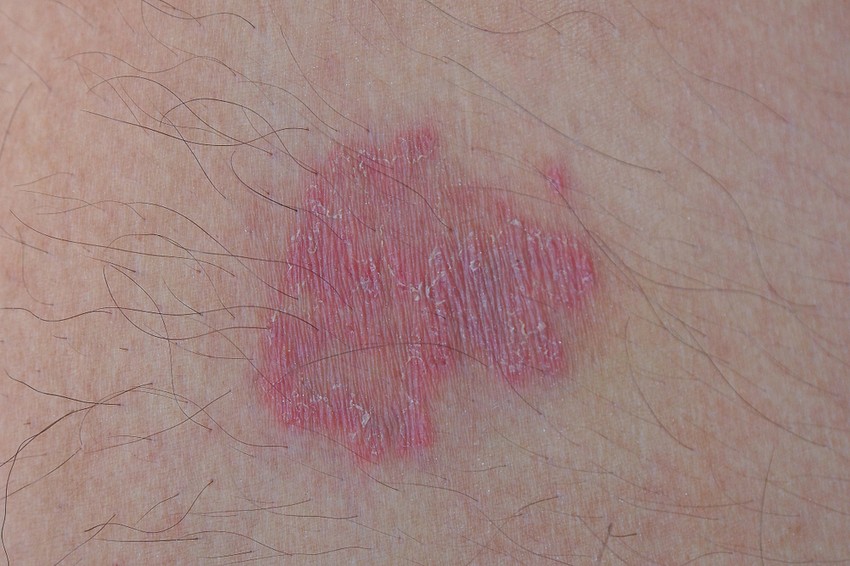 A betegség kialakulásában számos külső és belső tényező játszhat szerepet.Külső tényezők: kozmetikai krémek, kenőcsök, mosószerek, fluoridos fogkrém.Belső tényezők: a női nemi hormonok hatása.