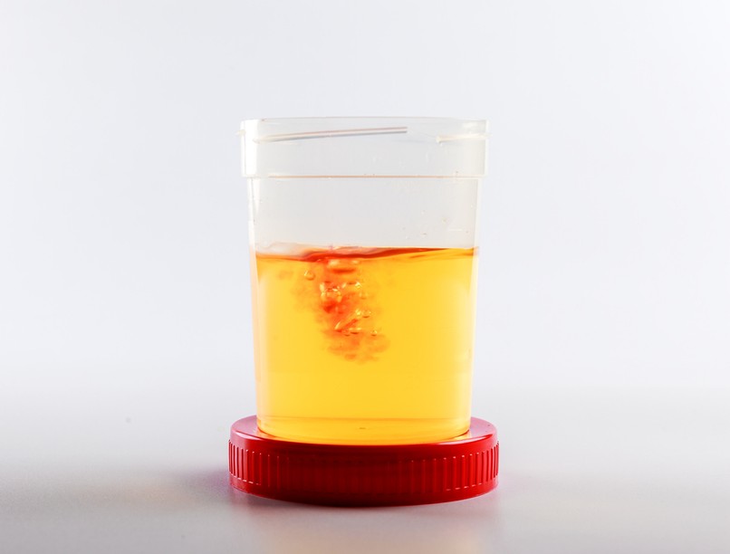 Mit jelent a véres vizelet haematuria tünet