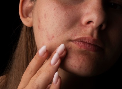 Felnőttkori pattanások: miért nem csak kamaszprobléma? című cikk nyitóképe