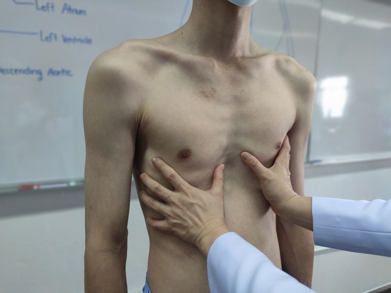 Mellkas deformitások tünetei, vizsgálata és kezelése