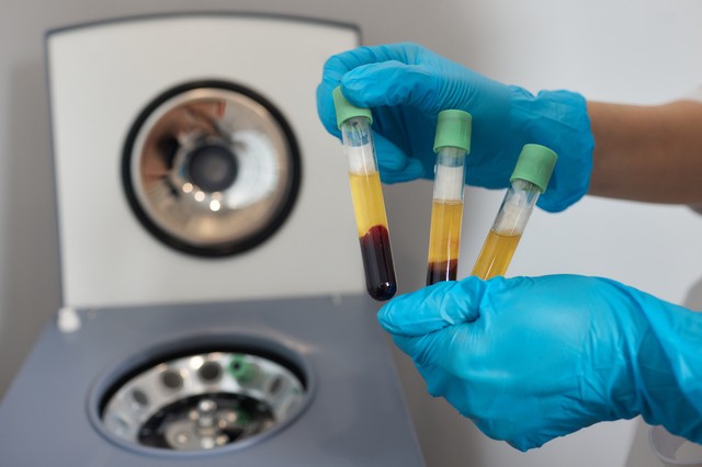 Mit jelent a trombocitaszám érték a laborleleten?