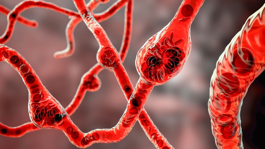 Az agyi aneurizma tünete lehet a fájdalomcsillapítóra nem szűnő kínzó fejfájás. Emiatt ha valakinek szokatlanul erős fejfájása lesz, érdemes lehet ez irányba vizsgálódni, kizárni ennek lehetőségét. Ha az aneurizma a mellkasban, az aortán van, a szívinfarktus tünetei, többek közt az erős mellkasi fájdalmak lehetnek árulkodóak.