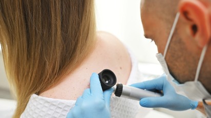 Bőrrákra utal-e az, ha vérzik az anyajegy? Ez a bőrgyógyász véleménye című cikk nyitóképe