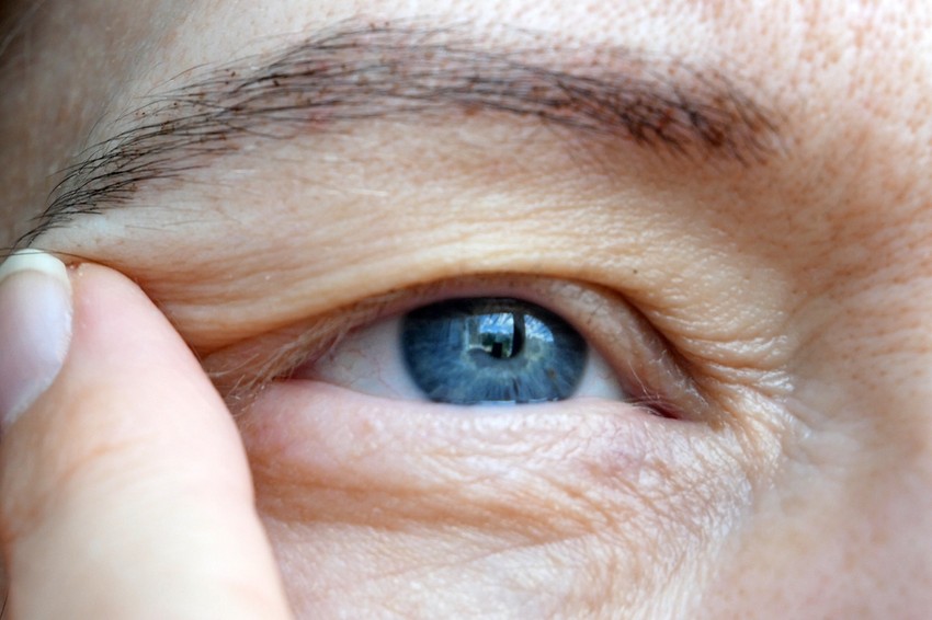 A szemhéj ilyen jellegű elváltozása diabéteszre utalhat.