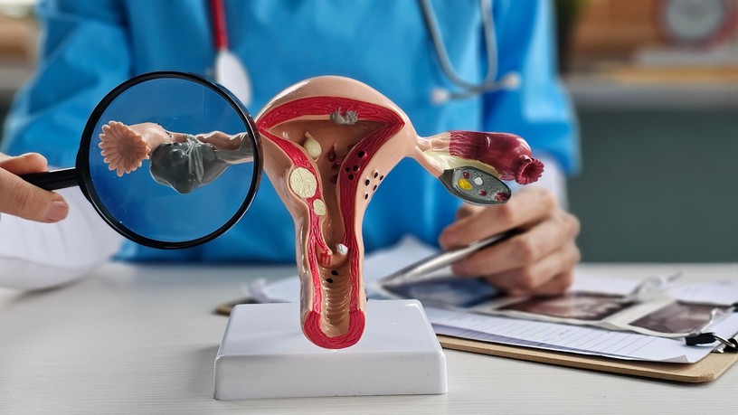PCOS-vizsgálat lépésről lépésre