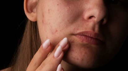 Felnőttkori pattanások: miért nem csak kamaszprobléma? című cikk nyitóképe