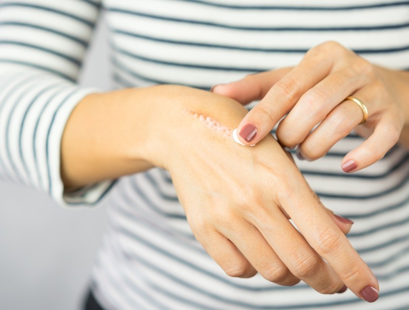 heg, ápol, múlik, nyomtalanul