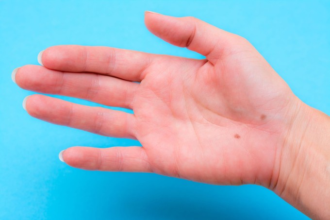 Mit jelent az anyajegy a tenyéren vagy a kézen? Kevesen tudják, hogy a jellemünk is kiolvasható belőle című cikk nyitóképe