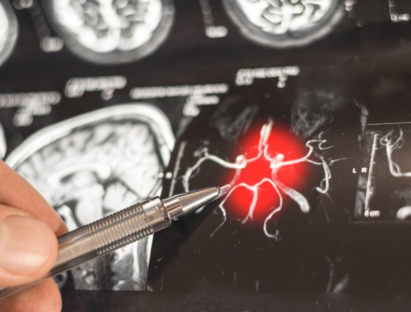 Alzheimer-kór visszafordítása kutatás igéretes eredmény