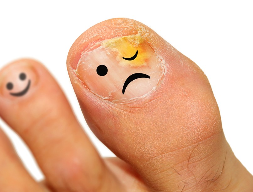 körömgomba, onychomycosis, otthoni gyógymód, lábköröm, sárga köröm