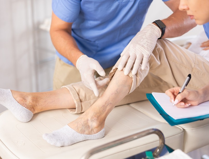 visszérbetegségek, visszértágulat, kánikula, nyár