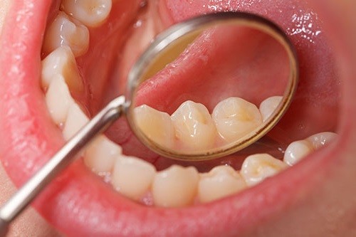 Valós veszély: a szájüregi rák terjedése