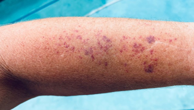 Leukémia: ezek a tünetek hívhatják fel rá a figyelmet - az éjszakai izzadás az egyik