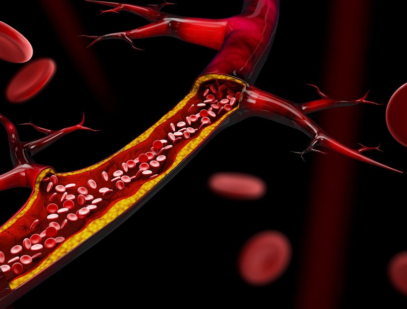 trombózis esély, hormonterápia, fogamzásgátló, trombofliák, lupus
