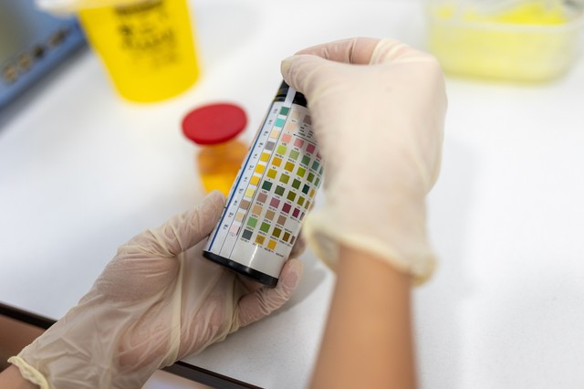 Mit jelez a vizeletszín a laborleleten?