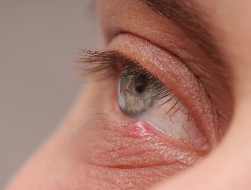 árpa szemen oka kezelése