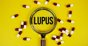 Lupusz – tünetek, diagnózis, kezelés: amit minden érintettnek tudnia kell
