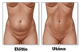 Gyógytornák: mi javasolt a hasplasztika után?