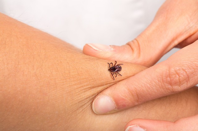Így tette tönkre a Lyme-kór a fiatal nő életét – nem vette komolyan a lábán megjelenő piros foltot