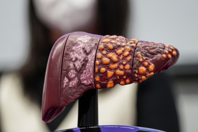Májrák és májáttétek: ezt kell tudni a kialakulásukról
