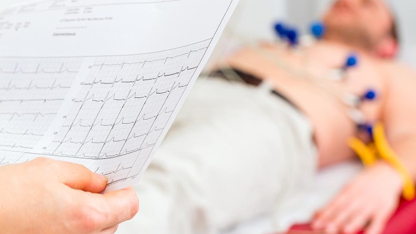 szívritmuszavar, EKG, szívinfarktus, dohányzás