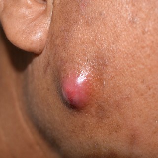 Mire utal a kelés a bőrön? című cikk nyitóképe