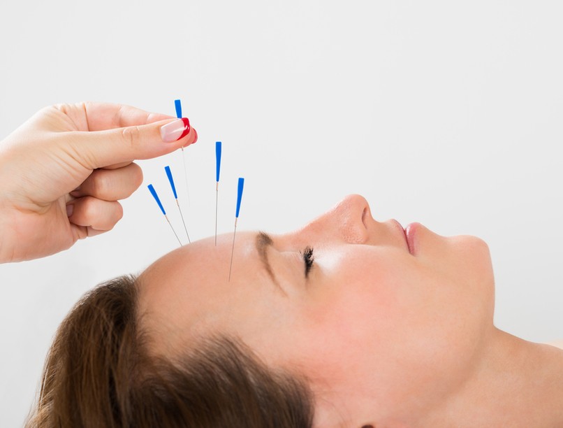 akupunkturas_kezeles