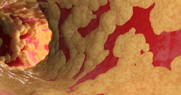  Koleszterin: napi szinten kérdezik az orvosokat ezekről - most itt vannak a válaszok! 