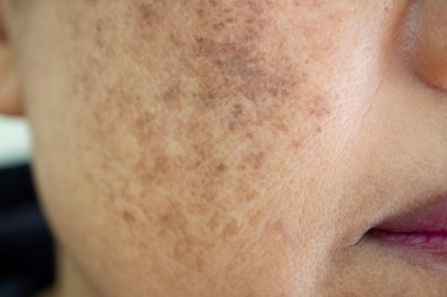 Kezd májfoltos lenni az arca? A bőrgyógyász elárulta, hogyan halványítók a foltok