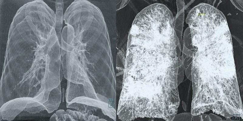Mi a tüdő CT és mit mutat ki?
