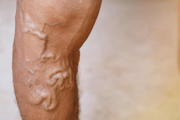 Vérrögképződés: így derülhet ki egy vérvizsgálatból a trombózishajlam című cikk nyitóképe