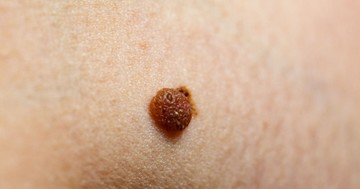  Ezek a tünetek árulkodnak arról, ha egy anyajegy rosszindulatúvá válik! 