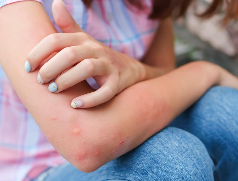 kiütés strandolás oka medence nap
