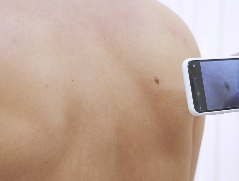 anyajegy, elváltozás, melanóma, fotó