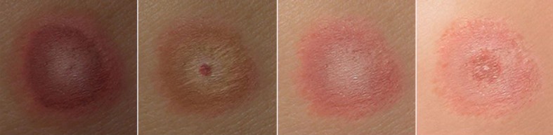 Lyme-fázisok. Lyme-kór okozta kiütések illusztrációja különböző bőrszíneken. Lyme-kóros betegeknél „bikaszem” alakú kiütés jelentkezhet. A kiütés fokozatosan terjed napok alatt.