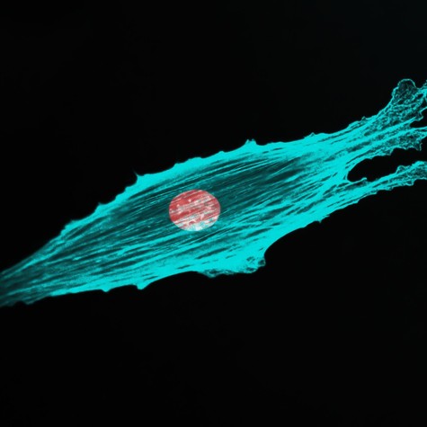 Megjósolhatóvá válhat az áttét? Új módszer jelezte, mekkora eséllyel képez áttétet a rák című cikk nyitóképe