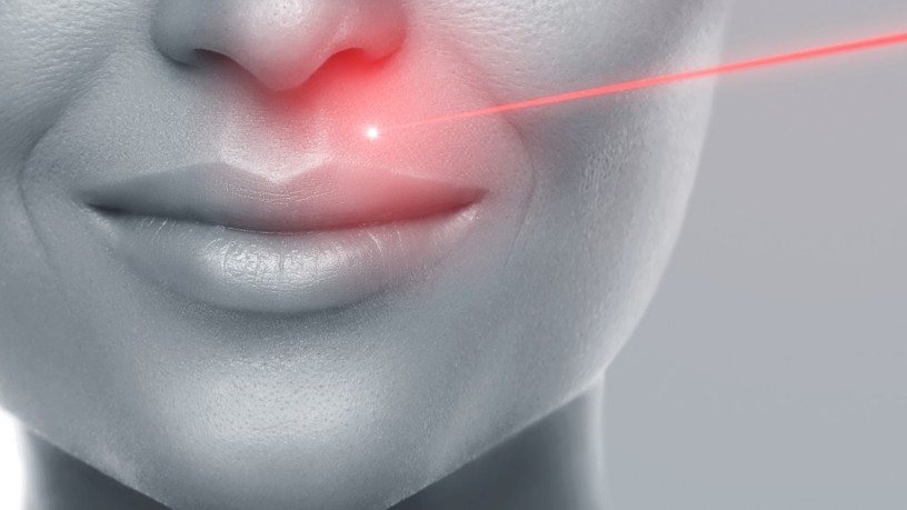 lézeres arcfiatalítás, kezelés, anti-ageing, frakcionált lézeres bőrfiatalítás
