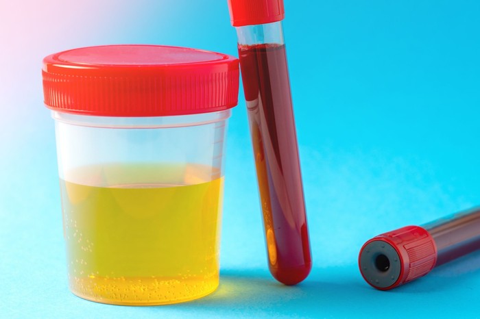 Öt módszer a magas húgysavszint csökkentésére