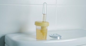 Így változik meg a széklet és a vizelet színe májbetegség esetén