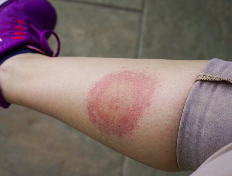 Lyme-kór, kezelés, kullancs, betegség, fertőzés