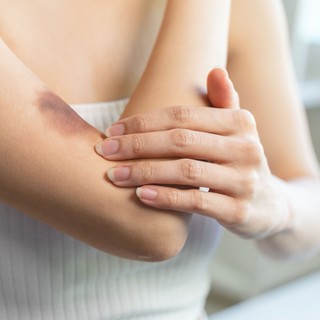 Zúzódások tünetei, vizsgálata és kezelése című cikk nyitóképe