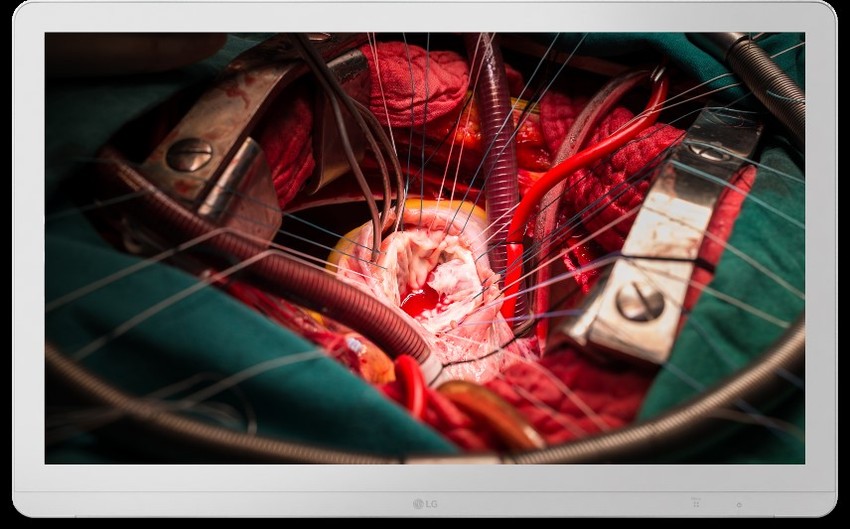 Magyarországra is megérkeztek az LG egészségügyi monitorai