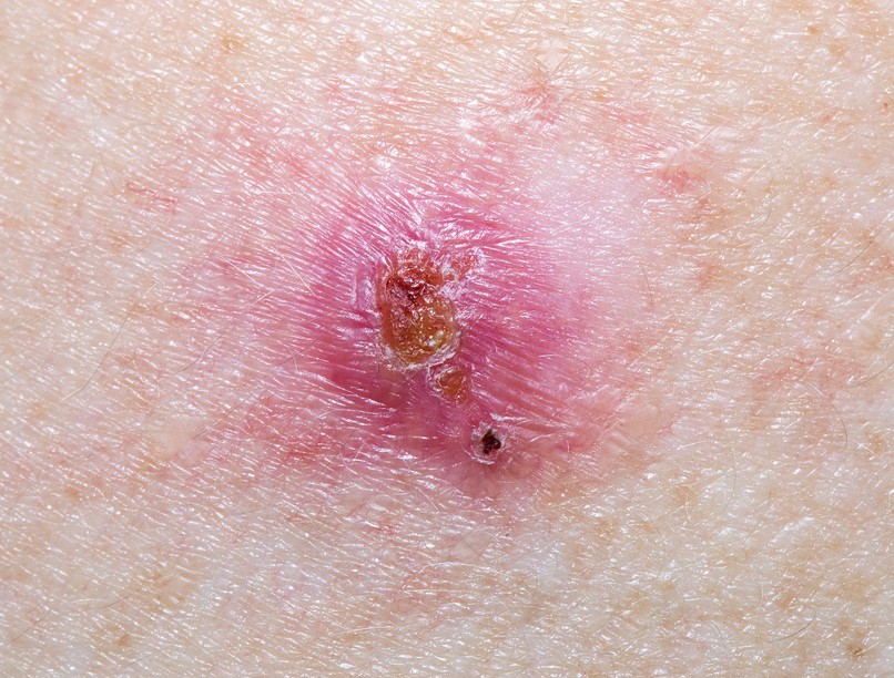 basalioma, bőrrák, daganat, bőrdaganat