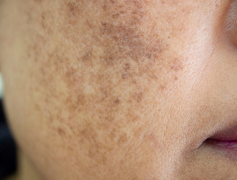 májfolt, öregségi folt, oka, napfény, melanóma