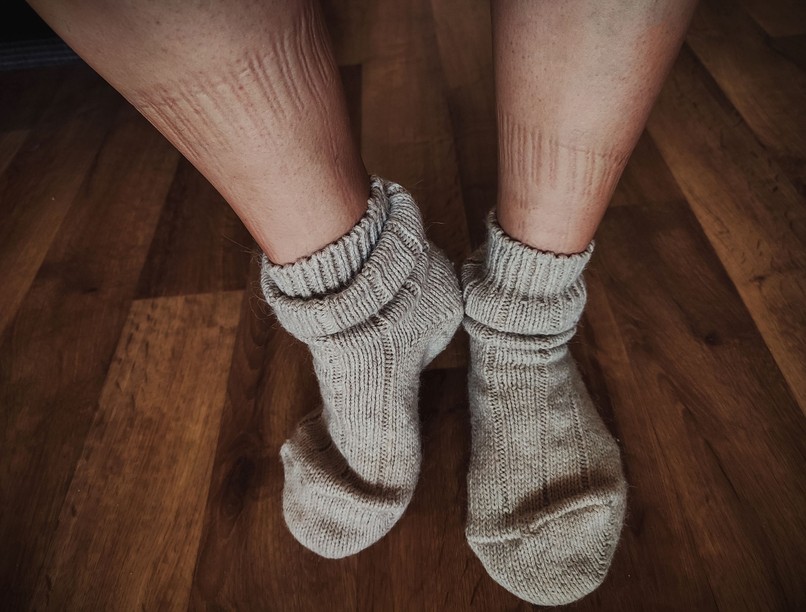 visszérbetegségek zokni nyoma lábon mitől