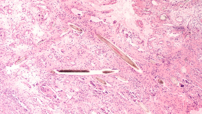 A pilonidális ciszta kialakulása során a mikroszkopikus sérülések gyógyulása közben szőrszál vagy a szennyeződés "beépülhet" a bőrbe, amelyre a szervezet veszélyesforrásként tekint, és fokozott immunreakcióval, gyulladással reagálhat. Az érintett területen baktériumok is elszaporodhatnak, még súlyosabbá téve ezzel a gyulladást.