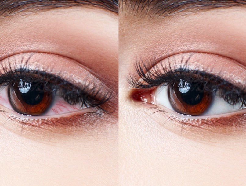 kotohartya_gyulladas